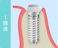 インプラント埋入手術について